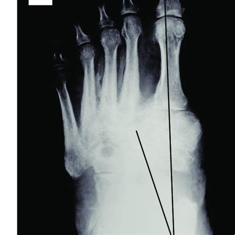 Preoperative 3d Ct Imaging Of The Left Foot The Osseous Destruction