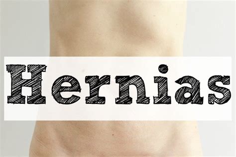 What Is An Umbilical Hernia Dr Rafael Lemus Rangel Medium