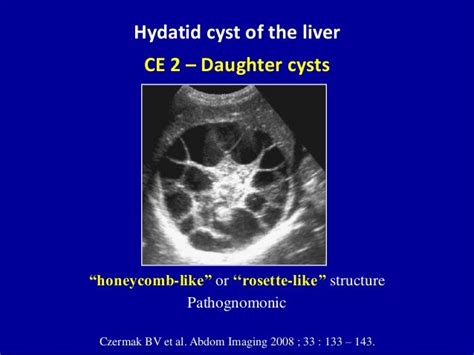 Hydatid Cyst Of The Liverce 2 Daughter Cysts“honeycomb Like” Or