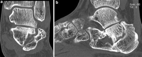Calcaneal Nonunion Three Cases And A Review Of The Literature