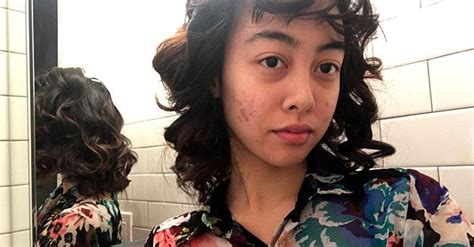 12 Beautiful Pictures Of Acne Scars