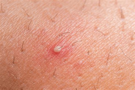 Common areas for ingrown hairs. Ingrown Hair : Overview, symptoms, causes, & proven ...