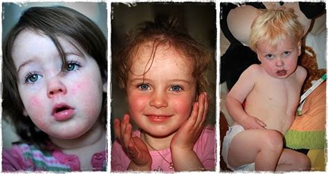 Top 18 Common Childhood Diseases Conditions And Disorders