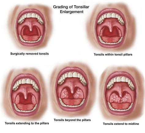 Tonsillar Hypertrophy