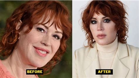 Molly Ringwald Plastic Surgery 2023 Botox Facelift And Stroke