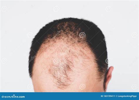 Male Pattern Hair Loss Problem Concept Baldness Alopecia In Males