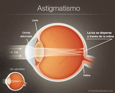 Lo que hay que saber sobre el astigmatismo Medicina Sociedad Bolívar