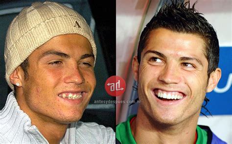 Celebrity Teeth Before And After Before And After Photos