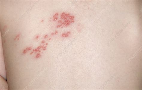 Shingles Rash On The Skin Stock Image C0168263 Science Photo Library