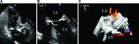 Two Cases Of Calcified Amorphous Tumor Mimicking Mitral Valve