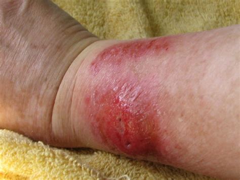 Many alleged cases of spider bites may represent incorrect diagnoses, which would make it more difficult to check the effectiveness of treatments for genuine bites. Spider Bite Page