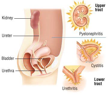 Urinary Tract Infection In Women Guide Causes Symptoms And Treatment Options