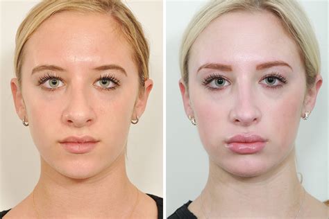 Rhinoplasty Nose Surgery Nose Job For Women In New York City David
