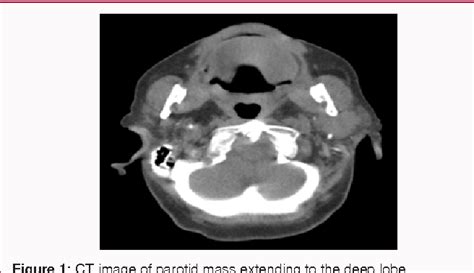 Figure 1 From Mucosa Associated Lymphoid Tissue Lymphoma Maltoma Of