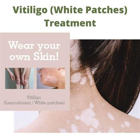 Vitiligo White Patches Treatment Skin Hair And Pain Treatment