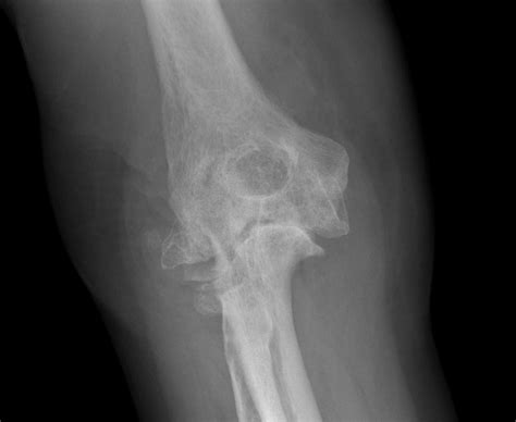 Rheumatoid Elbow The Bone School