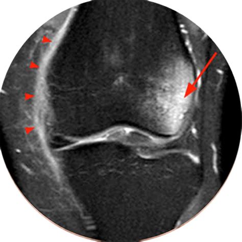 Edema Da Gordura Infrapatelar Lateral