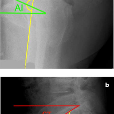 A B Lateral Radiographs Of A Stiff Pelvis Patient In A Standing And B