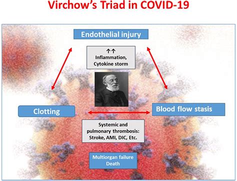 Covid‐19 Thromboembolic Risk And Virchows Triad Lesson From The