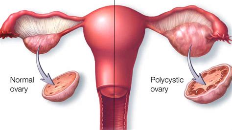 Lifestyle And Illness Uterine Fibroids And Ovarian Cysts Ayoti Blog