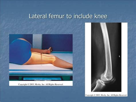 Femur To Knee Lateral X Ray Polymed Lab
