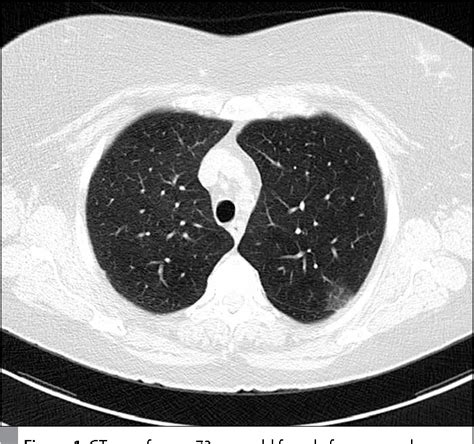 Pdf Screening For Lung Cancer With Low Dose Ct Scans Semantic Scholar