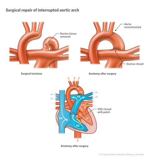 Cardiology Interrupted Aortic Arch