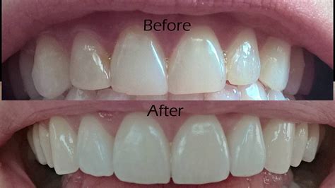Dental Veneers Help To Perfect Smiles