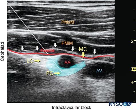Ultrasound Guided Infraclavicular Brachial Plexus Nerve Block Nysora