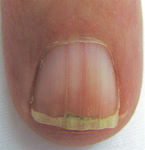 Common Nail Changes And Disorders In Older People The College Of