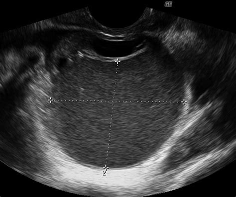 Transvaginal Pelvic Ultrasound Scan Of Ovarian Endometriomas