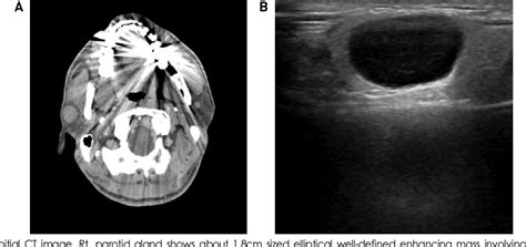 Figure 1 From A Case Report Of Malt Lymphoma In Parotid Gland
