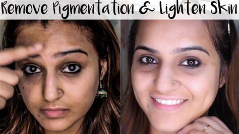 How To Get Rid Of Pigmentation Dark Spots Discoloration And Lighten