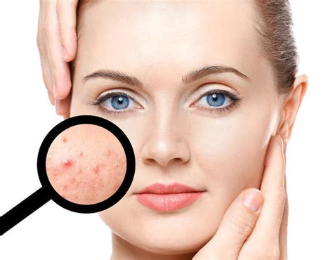 Hormones And Acne What You Should Know Specialists In Dermatology
