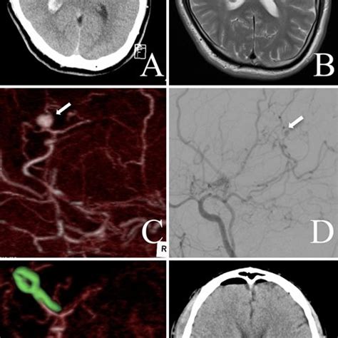 Case 1 A Axial Ct Scan Showing A Right Intraventricular Hemorrhage