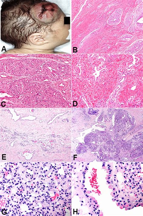 Congenital Hemangioma Presenting As A Fully Developed Cutaneous Lesion