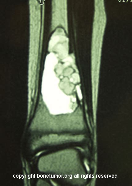 Aneurysmal Bone Cyst Tibia