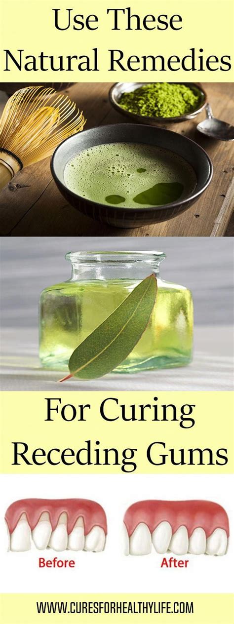Use These 4 Natural Remedies For Curing Receding Gums Treatgumdisease