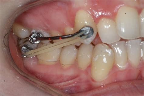 Appareil Orthodontique Carriere® Denis Bernard Orthodontiste