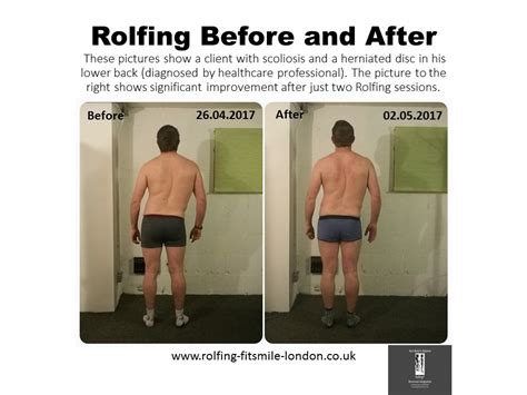 Rolfing Before And After Photos Rolfing And Personal Training In London