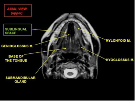 Tongue Muscles Mri Anatomy