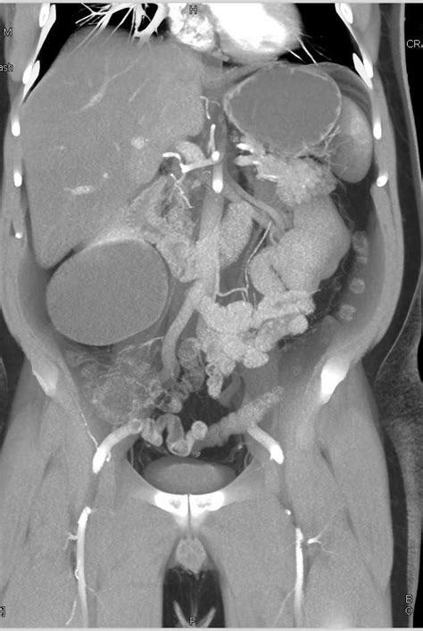 Bosniak 2f Cyst Right Kidney In 2021 Ct Scan Radiology