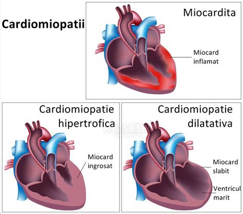 Pentru miocardita poate fi acută sau cronică. Cardiomiopatiile (CM)