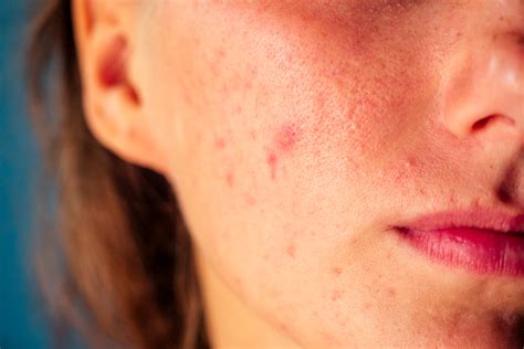 Skin Conditions Caused By Stress And Anxiety Bekam Menghilangkan