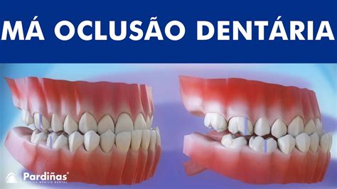 Face Oclusal Do Dente
