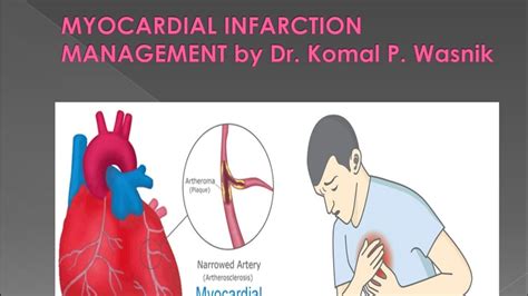 Myocardial infarction, commonly known as a heart attack, is the irreversible necrosis of heart muscle secondary to prolonged ischemia. Management of Heart Attack ( Myocardial Infarction) in OPD ...