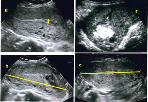 Ultrasound By Midwives In The Postpartum Period Feasibility Reproducibility And Midwives