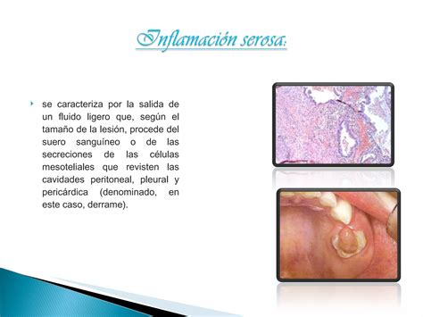 Inflamacion Aguda Y Cronica Ppt