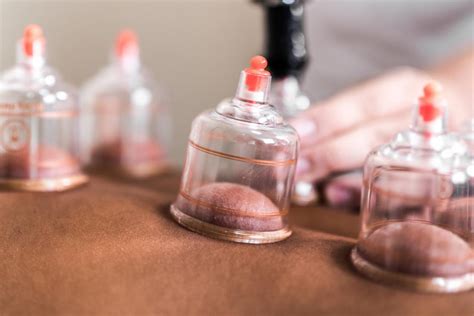 Does Cupping Therapy Work And What Are The Benefits