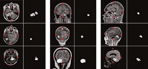 Automatic Segmentation Of Brain Tumors In Magnetic Resonance Imaging